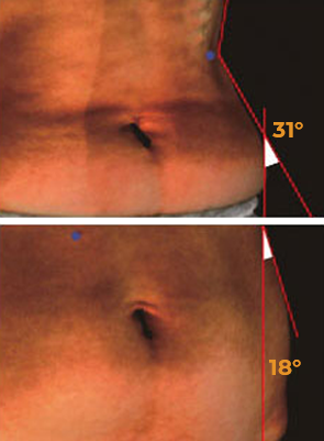 Analyzes images of sagging abdomen tightening effect